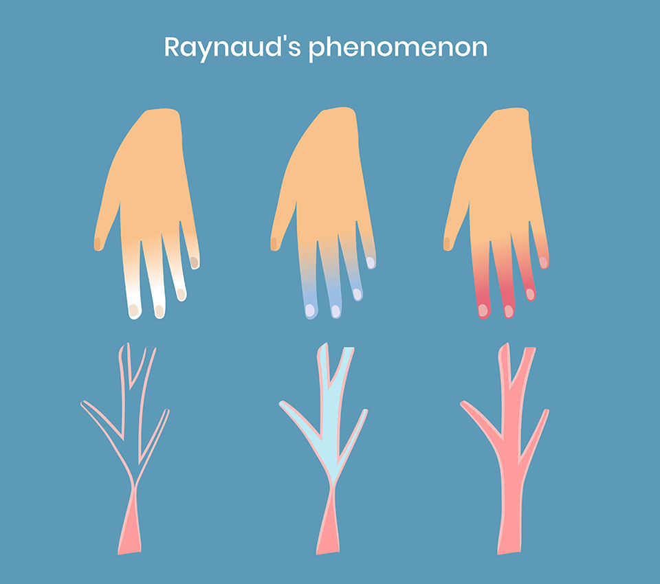 Quels sont les symptômes de raynaud